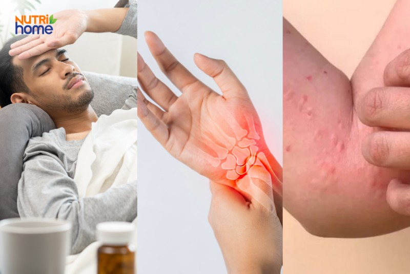 Triệu chứng bệnh Chikungunya gồm sốt cao, đau khớp và phát ban trên da