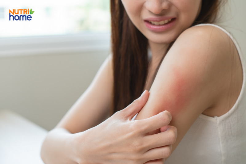Phụ nữ bị mẩn đỏ vùng cánh tay, cảm giác khó chịu do viêm da