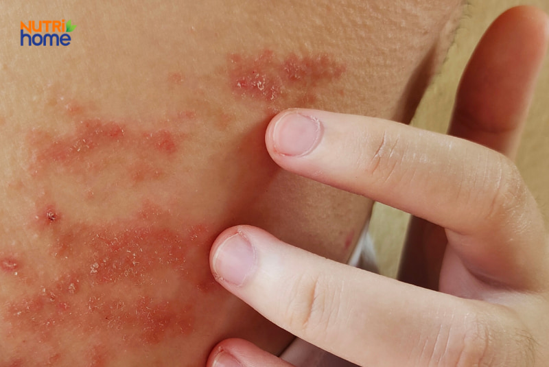 Viêm da cơ địa (Eczema/Atopic Dermatitis)