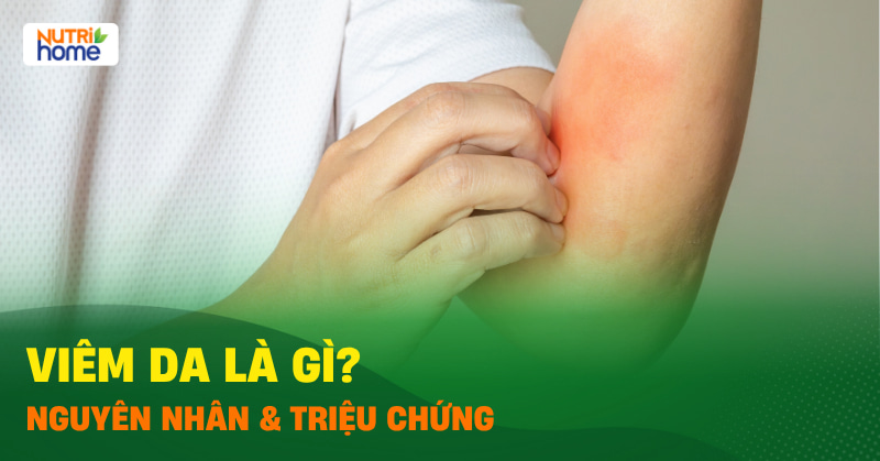 viêm da