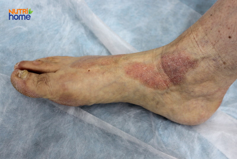 Viêm da thần kinh (Lichen Simplex Chronicus)