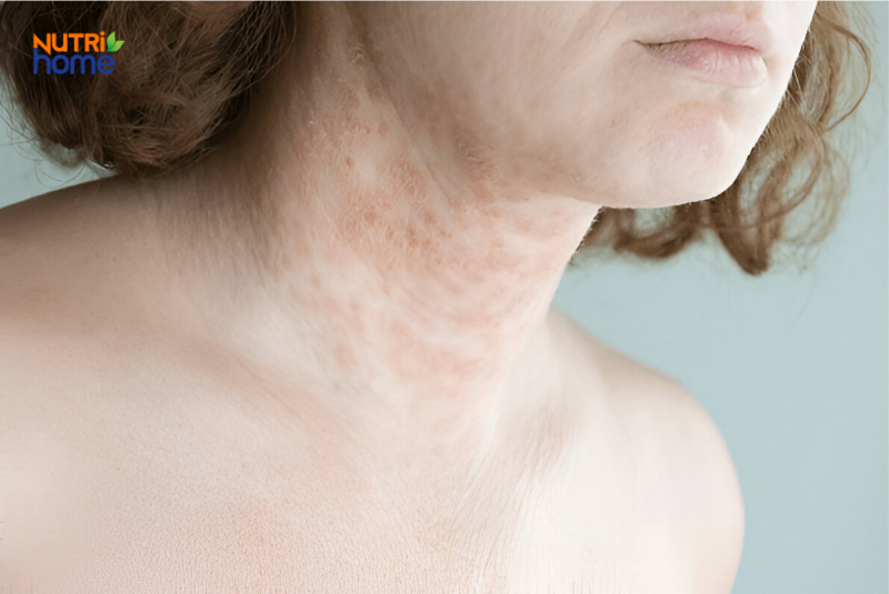 Vùng cổ người lớn bị viêm da cơ địa với biểu hiện đỏ rát và khô da
