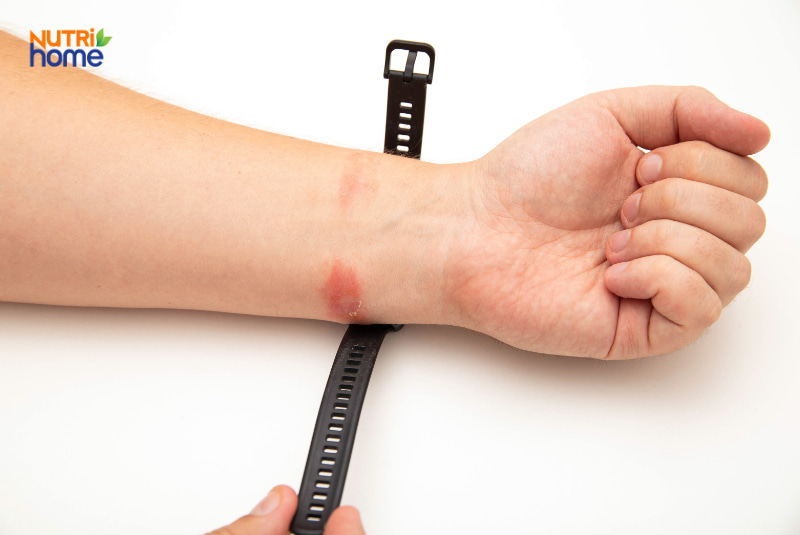 Viêm da tiếp xúc (Contact Dermatitis)