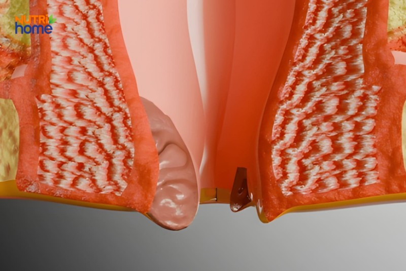 Hình ảnh mô phỏng búi trĩ sa ra ngoài trong bệnh trĩ ngoại nghiêm trọng