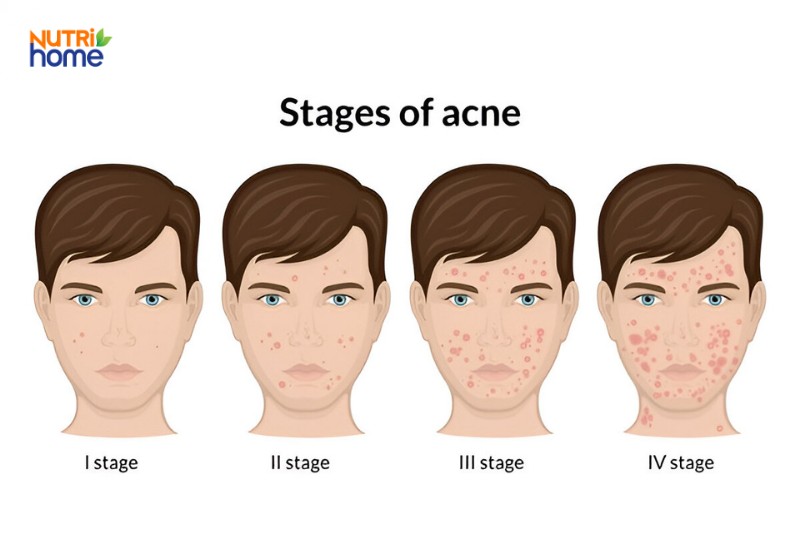 Các giai đoạn phát triển của mụn trứng cá từ nhẹ đến nặng