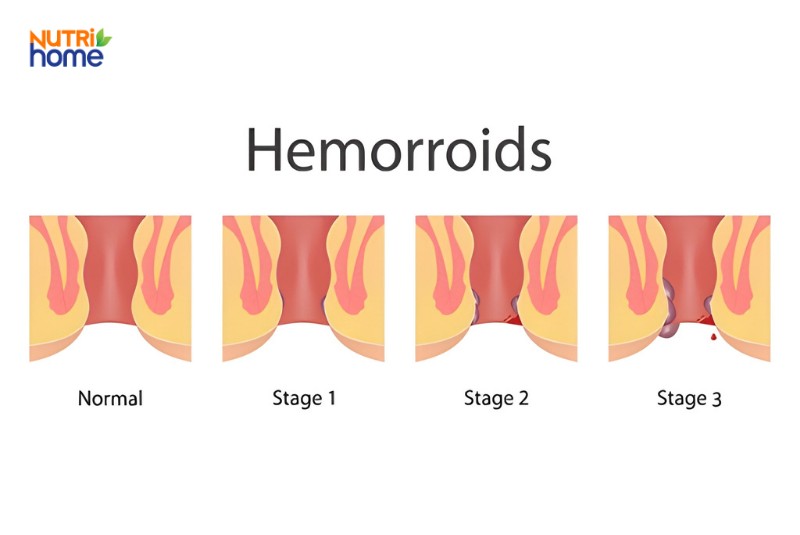 Hình ảnh so sánh các giai đoạn bệnh trĩ từ bình thường đến độ 3