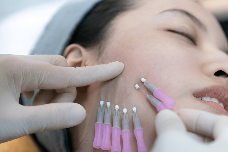 Căng chỉ da mặt là phương pháp thẩm mỹ hiện đại giúp chống chảy xệ