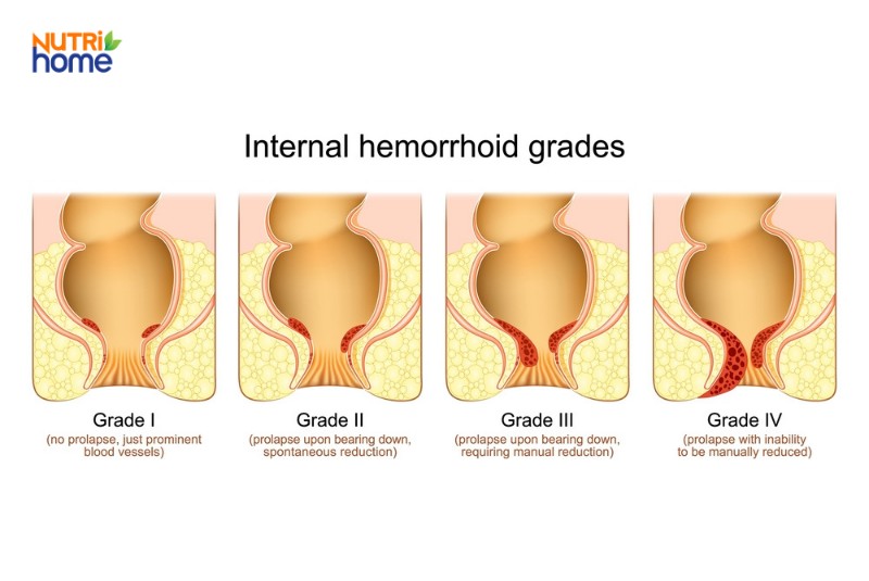 Hình mô phỏng các cấp độ trĩ nội từ độ 1 đến độ 4 dựa theo mức độ sa búi trĩ