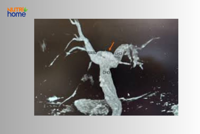 Hình ảnh chụp cắt lớp hệ thống đường mật với nhánh gan trái và gan phải rõ ràng