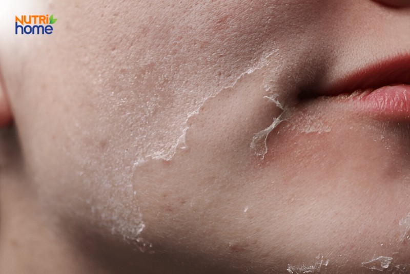 Làn da bong tróc do thiếu ẩm cần được chăm sóc và dưỡng ẩm đúng cách