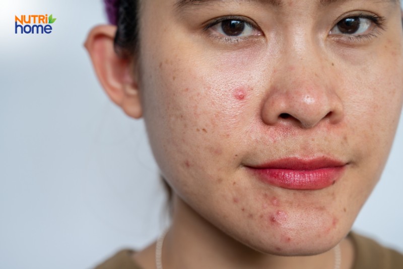 Gương Mặt Phụ Nữ Có Làn Da Dầu Nổi Nhiều Mụn Đỏ Ở Má Và Cằm