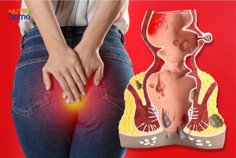 Người phụ nữ đau rát vùng hậu môn kèm hình ảnh mô phỏng cấu trúc trực tràng