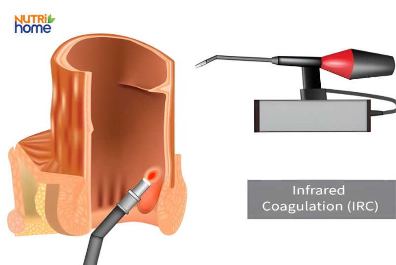 Mô phỏng điều trị trĩ nội bằng tia hồng ngoại với thiết bị chuyên dụng