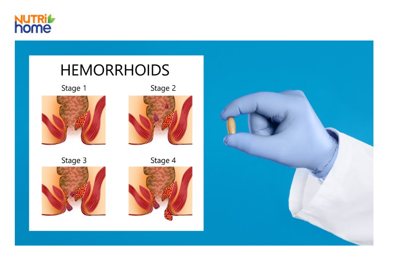 Hình ảnh minh họa 4 giai đoạn bệnh trĩ nội, bác sĩ cầm viên thuốc hỗ trợ