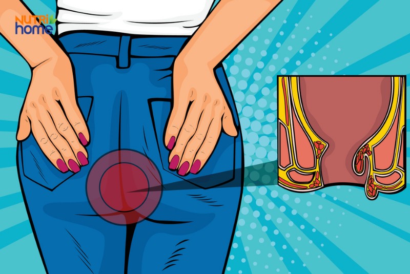 Minh họa vị trí búi trĩ ngoại ở hậu môn qua hình vẽ y khoa