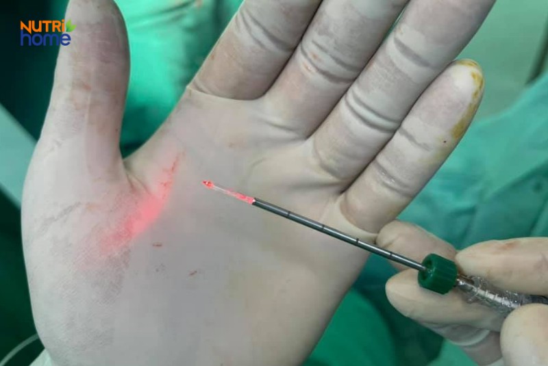 Dụng cụ laser trong phẫu thuật điều trị bệnh trĩ