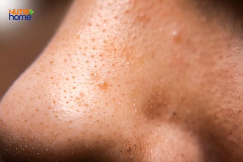 Mụn đầu đen và lỗ chân lông to vùng mũi dưới ánh sáng tự nhiên