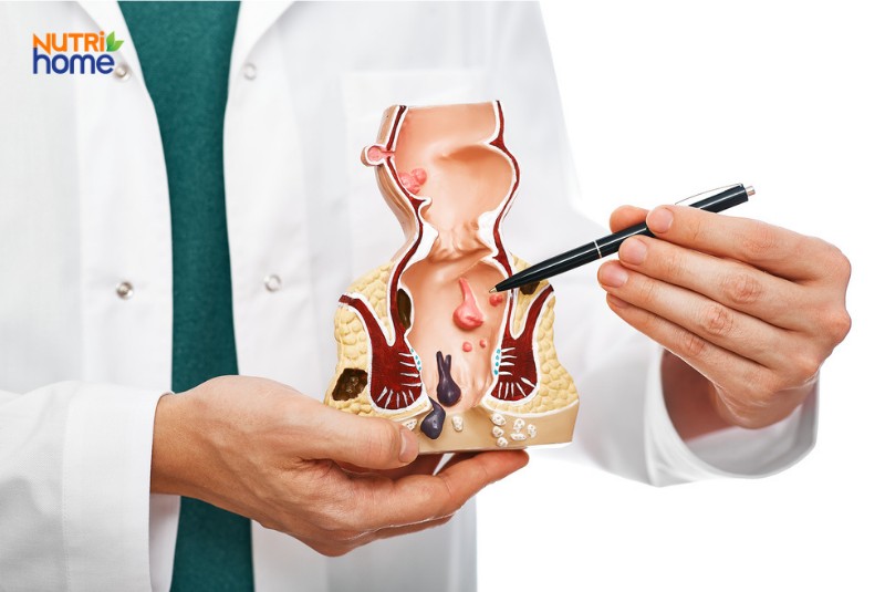 Mô hình giải phẫu hậu môn minh họa bệnh trĩ hỗn hợp nội và ngoại