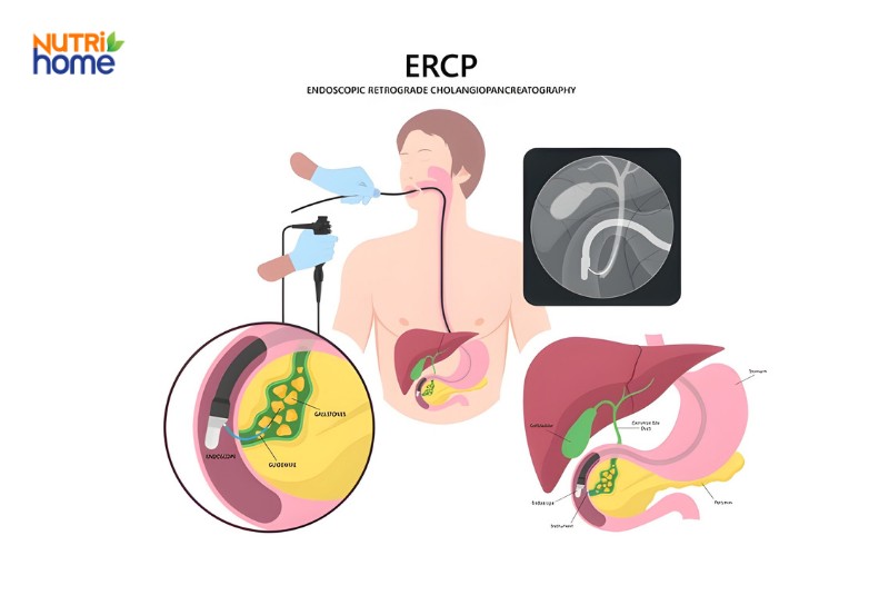 Mô phỏng kỹ thuật ERCP nội soi mật tụy ngược dòng trong chẩn đoán và điều trị bệnh túi mật