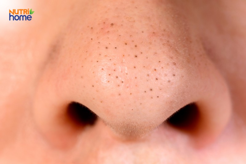 Vùng Mũi Có Nhiều Mụn Đầu Đen Và Lỗ Chân Lông To Do Da Dầu