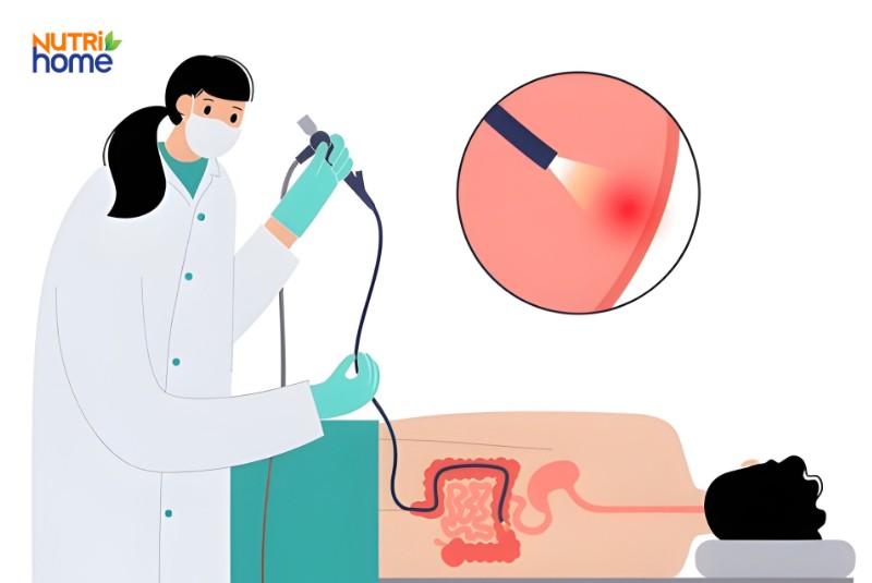 Bác sĩ nội soi hậu môn kiểm tra dấu hiệu trĩ nội độ 2