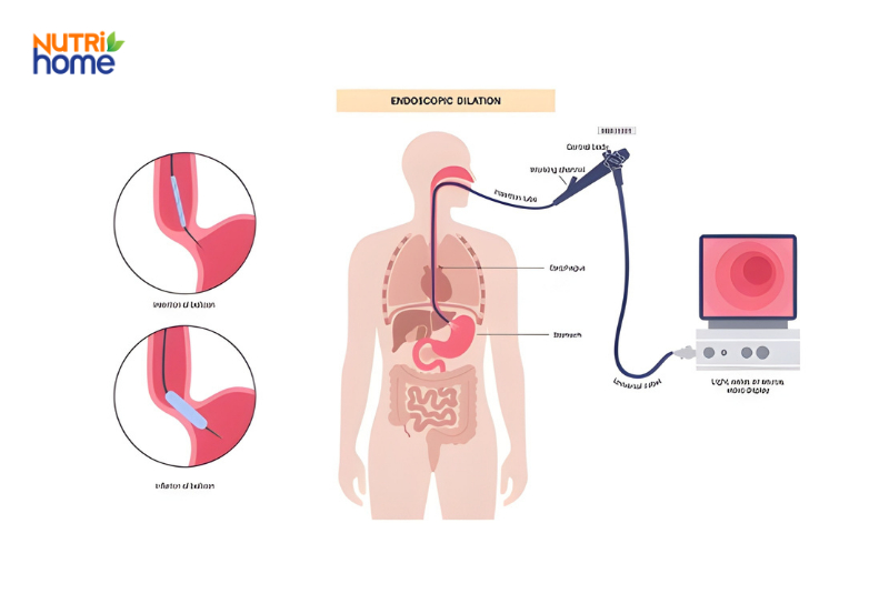 Minh họa quy trình nội soi điều trị hẹp thực quản liên quan đến trào ngược dịch mật.