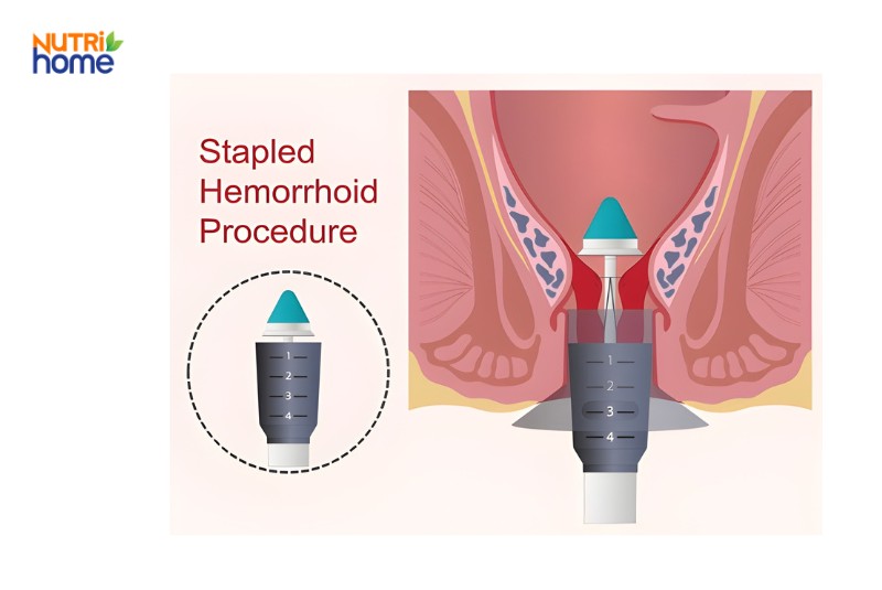 Hình ảnh mô phỏng kỹ thuật khâu treo búi trĩ bằng dụng cụ stapler
