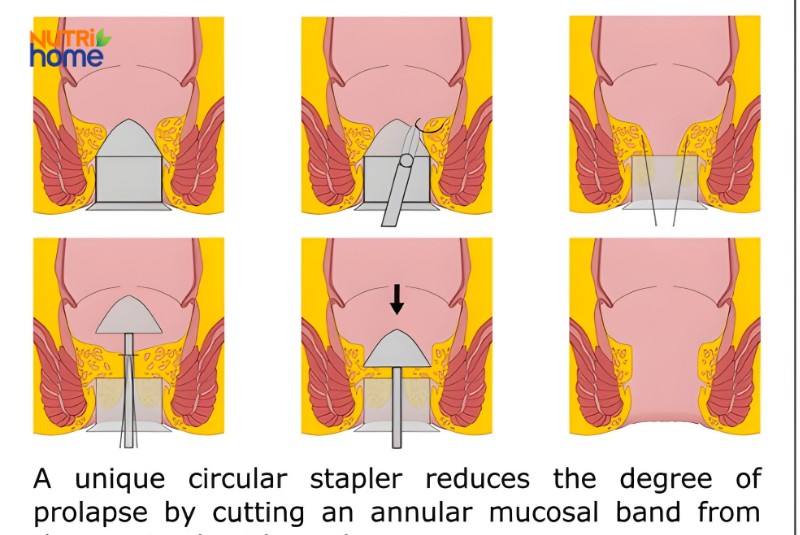 Hình minh họa kỹ thuật phẫu thuật Longo điều trị trĩ nội độ 4