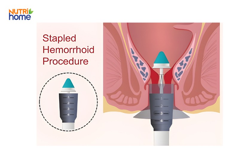 Minh Họa Kỹ Thuật Phẫu Thuật Khâu Vòng Điều Trị Trĩ Nội Hiện Đại