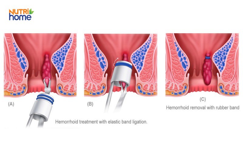 Minh họa phương pháp thắt búi trĩ nội bằng vòng cao su trong điều trị y khoa