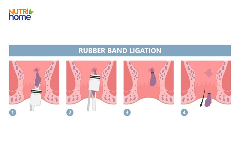 Minh họa các bước thắt búi trĩ bằng vòng cao su trong điều trị trĩ nội
