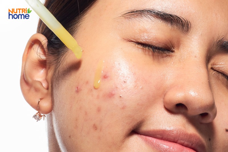 Serum Chăm Sóc Da Dầu Mụn Được Thoa Lên Vùng Má Có Nhiều Nốt Viêm Đỏ