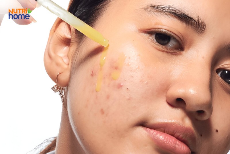 Cô gái thoa serum lên vùng da bị mụn đỏ và thâm