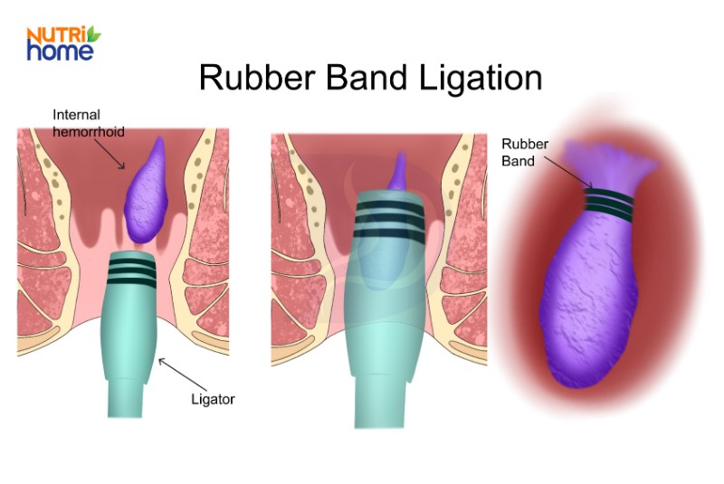 Minh họa thắt búi trĩ nội bằng vòng cao su trong điều trị không phẫu thuật
