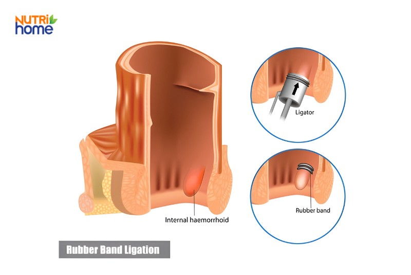 Mô phỏng kỹ thuật thắt búi trĩ nội độ 2 bằng vòng cao su
