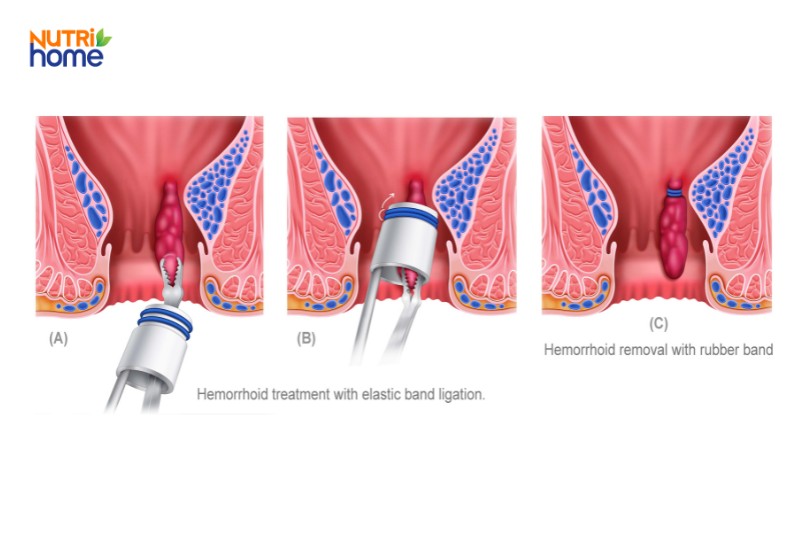 Các bước điều trị trĩ bằng thắt búi trĩ bằng vòng cao su