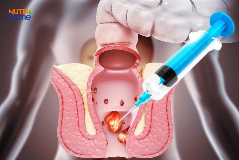 Mô phỏng kỹ thuật tiêm xơ để điều trị búi trĩ nội