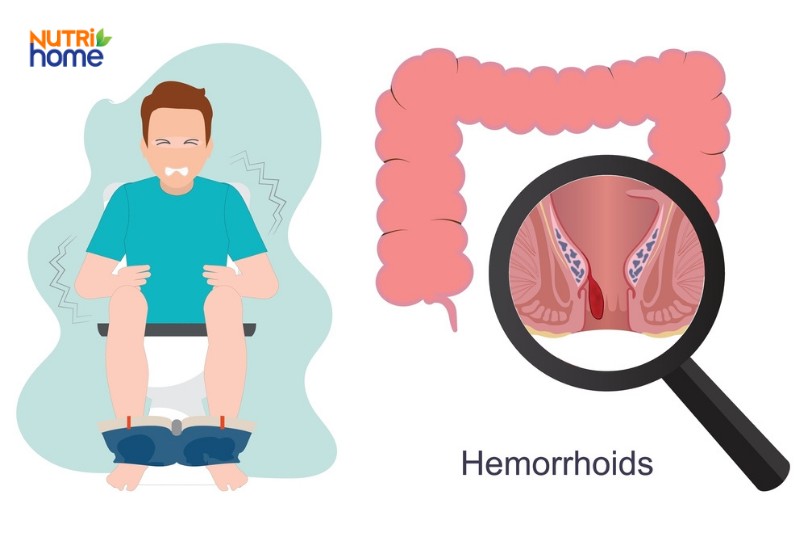 Hình minh họa người đau bụng do trĩ nội và hình ảnh búi trĩ qua trực tràng