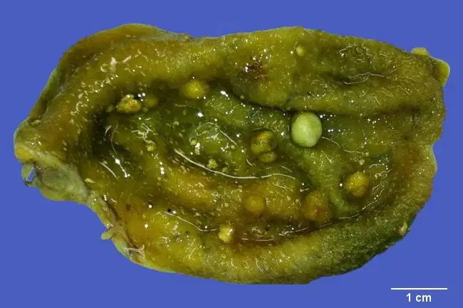 Minh họa các hạt cholesterol polyp.