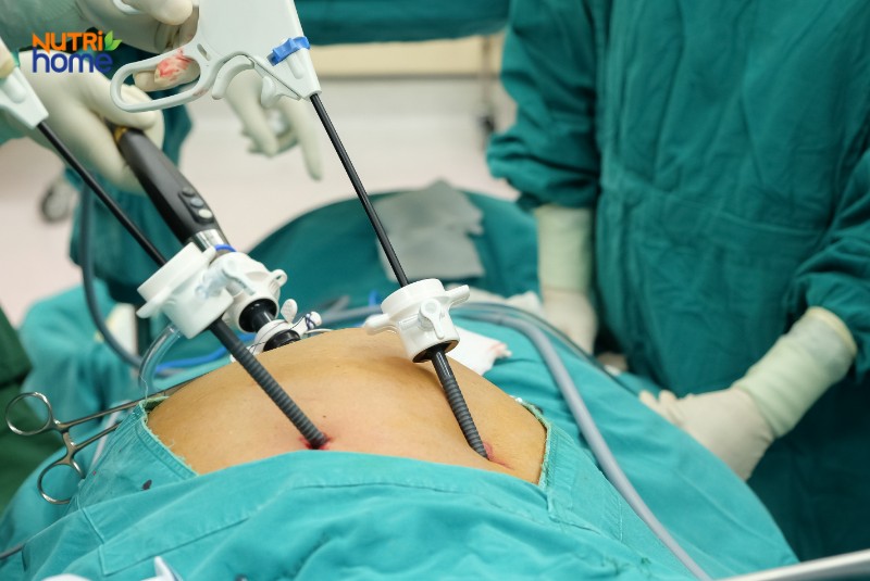 Quá trình phẫu thuật cắt túi mật nội soi với thiết bị y tế chuyên dụng