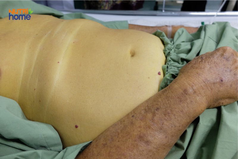 Bệnh nhân bị vàng da toàn thân, dấu hiệu điển hình của ung thư đường mật giai đoạn tiến triển