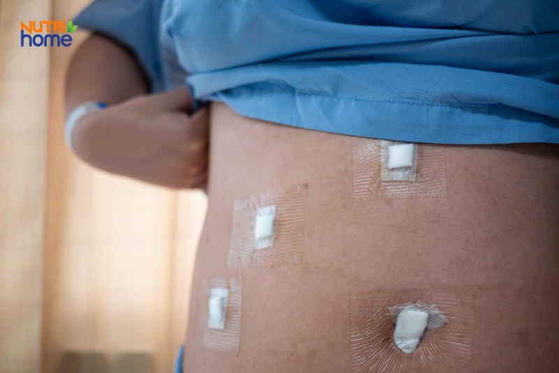Vết mổ nội soi vùng bụng sau phẫu thuật sỏi mật được dán băng y tế