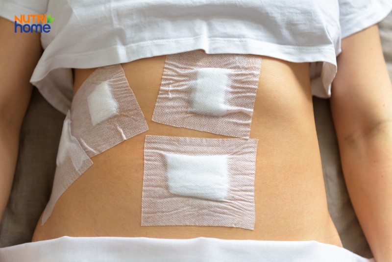 Vết mổ vùng bụng sau phẫu thuật cắt túi mật nội soi, được dán băng y tế