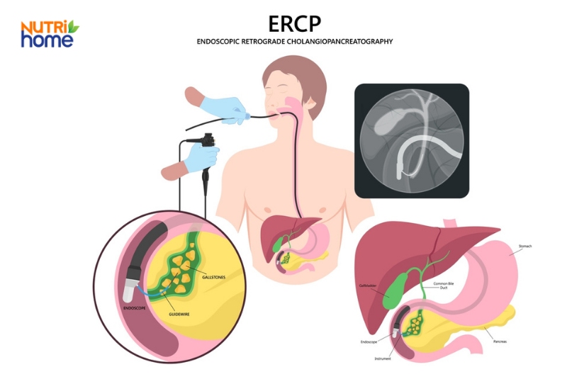 Phương pháp ERCP giúp chẩn đoán và điều trị các bệnh lý tụy như tắc nghẽn ống tụy