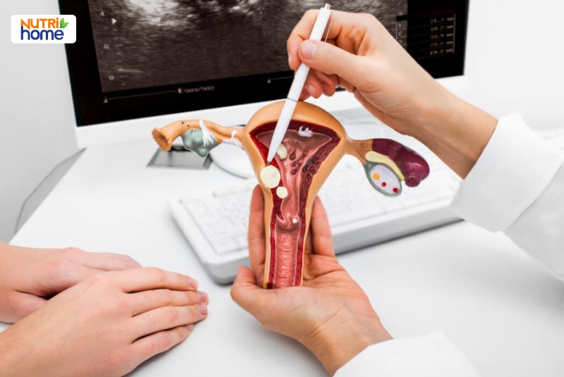 Mô hình tử cung minh họa vị trí tế bào ung thư trong cổ tử cung