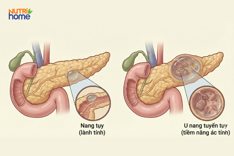 Hình ảnh so sánh nang tụy lành tính và u nang tuyến tụy có nguy cơ ác tính
