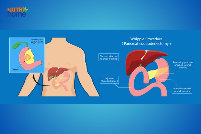 Minh họa quy trình phẫu thuật Whipple điều trị ung thư tụy
