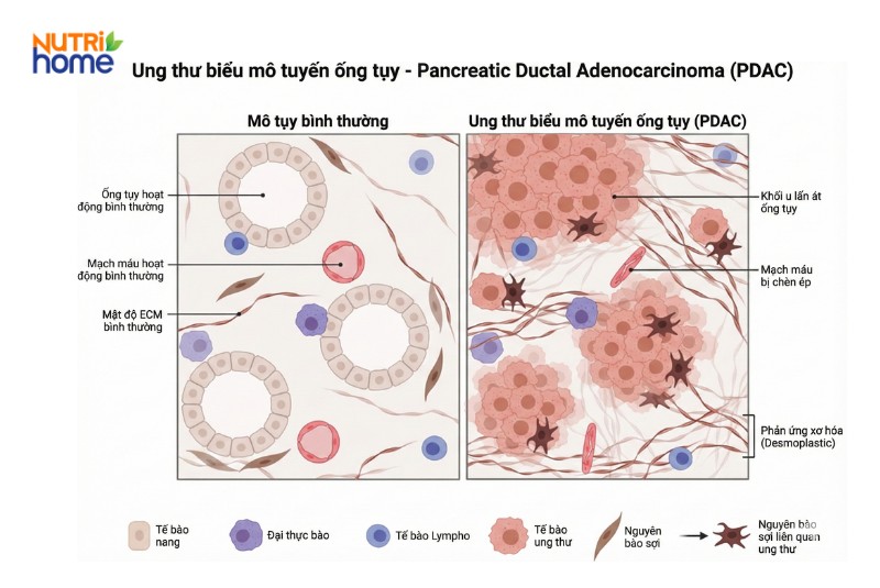 Hình ảnh so sánh mô tụy bình thường và mô tụy bị ung thư biểu mô ống tụy