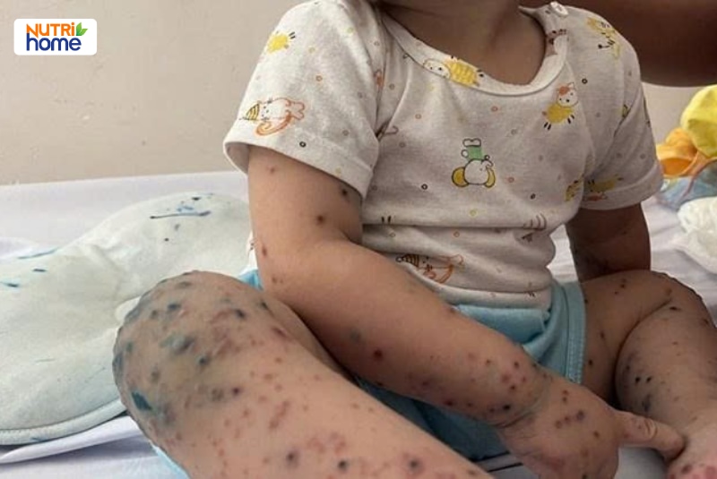 Bé nhỏ ngồi trên giường với nhiều nốt phát ban trên chân và tay
