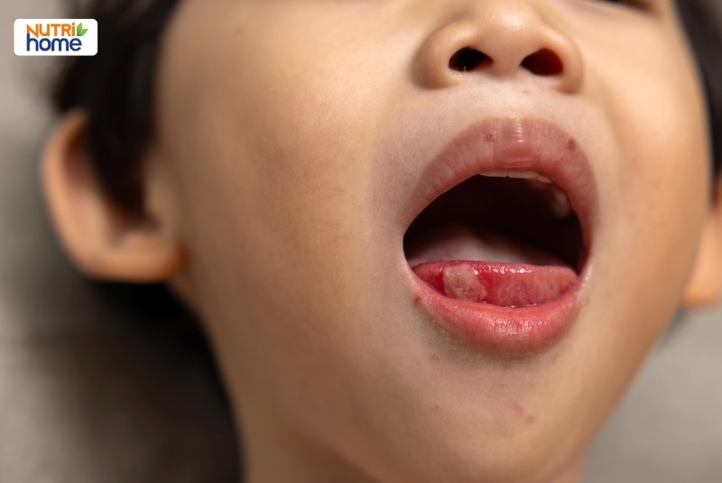 Trẻ há miệng cho thấy vết loét đỏ ở niêm mạc môi dưới và nốt đỏ quanh miệng